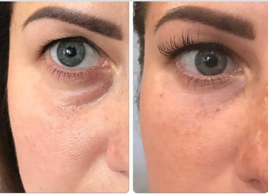 Original side-by-side photographs of the under-eye area