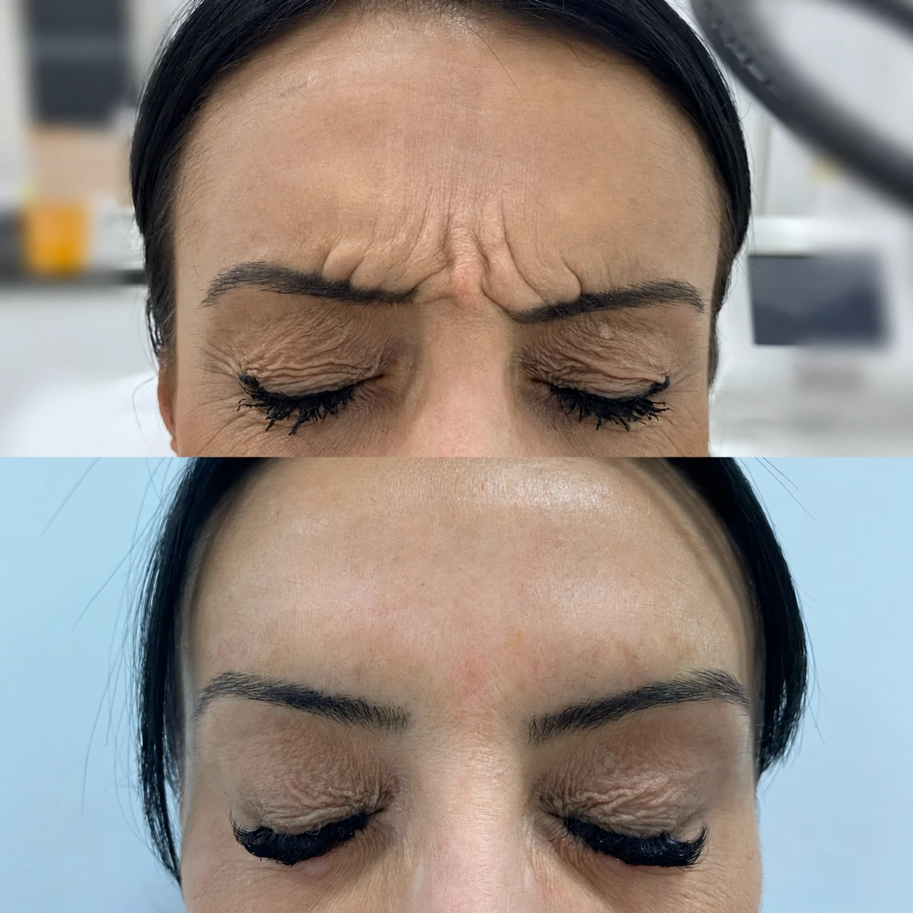 Two forehead treatment photographs