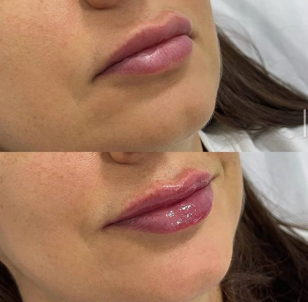Two original close-up lip treatment photographs