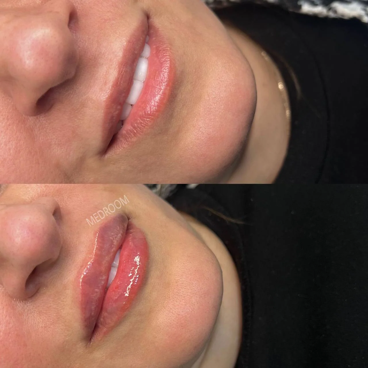 Another pair of original lip treatment photographs